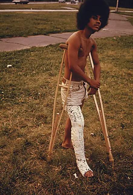 Young Man With His Leg In A Cast In Highland Park.